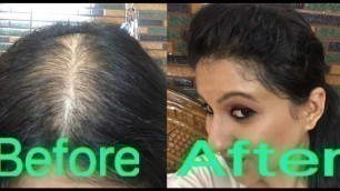 'How to style your hair in partial alopecia to hide bald spots'